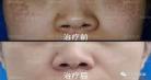 褐青色痣哪种皮秒好