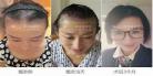 发际线从哪里算起